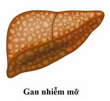 Xơ gan giai đoạn đầu sống được bao lâu và dấu hiệu của bệnh Xơ gan giai đoạn đầu sống được bao lâu và dấu hiệu của bệnh