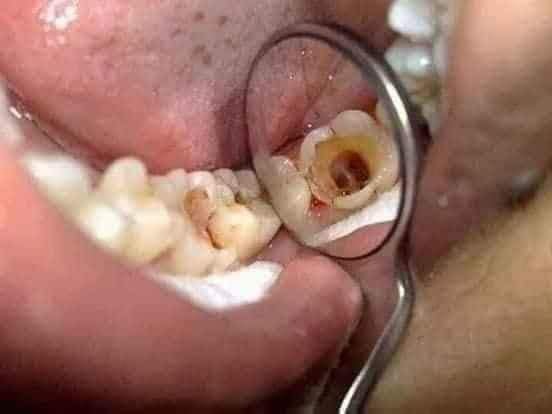 Thuốc chữa sâu răng của người dao đỏ cam kết chữa khỏi bệnh lý về răng miệng