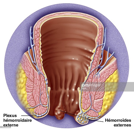 Hình ảnh bệnh trĩ qua từng giai đoạn