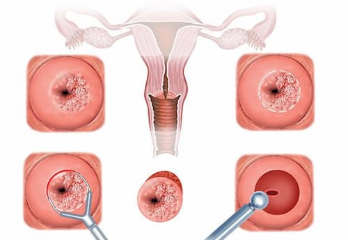 Phương pháp chữa viêm cổ tử cung